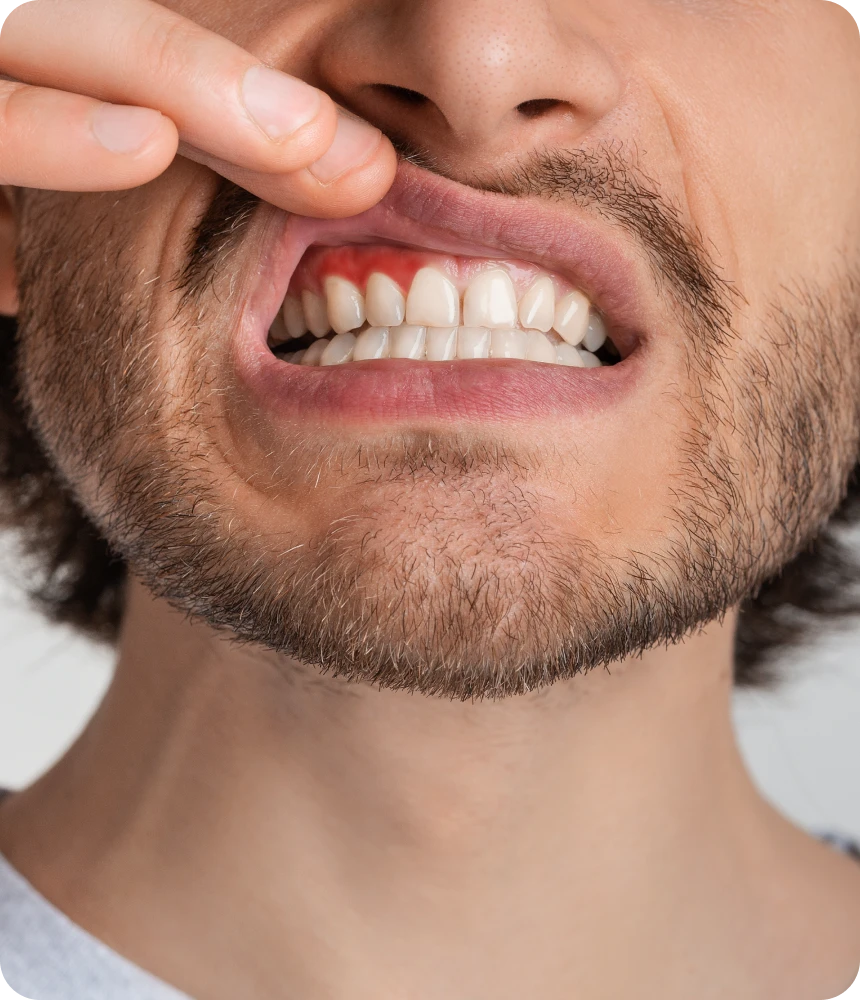 Gingivite, parodontite