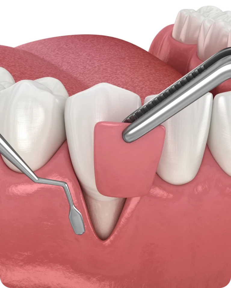 Traitement correctif de la gencive