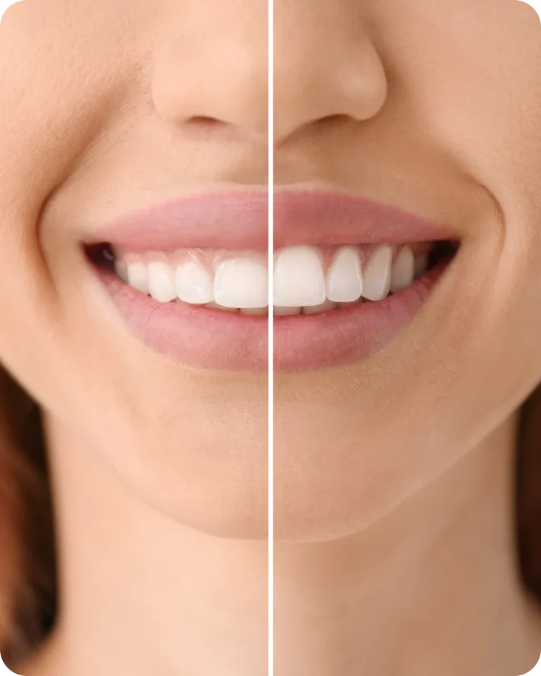 Correction gingivale esthétique