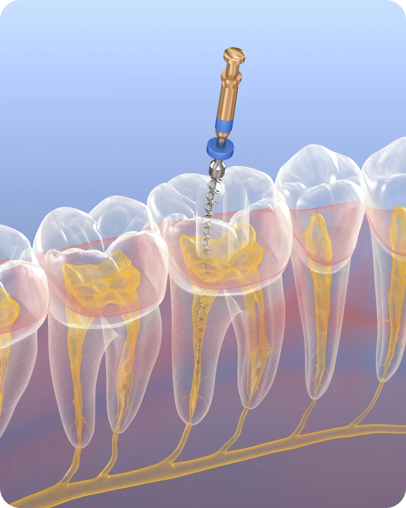 Implants dentaires