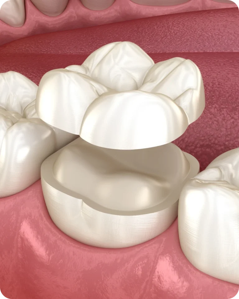 Prothèses adhésives modernes