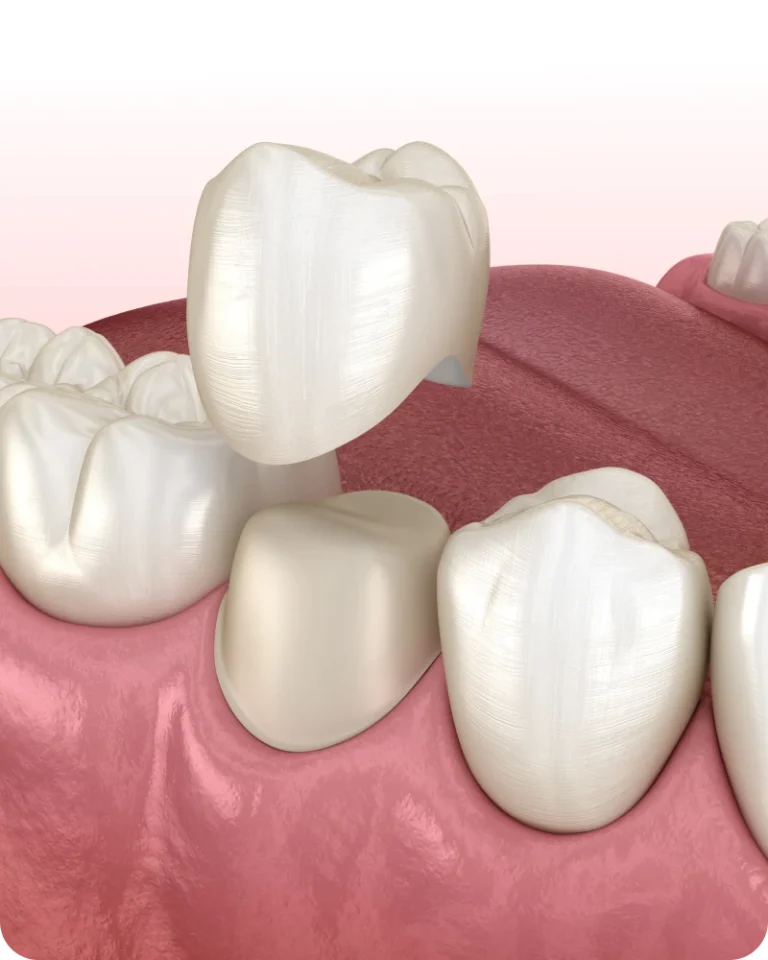 Prothèses conventionnelles