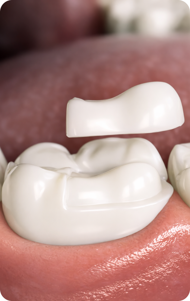 Dentisterie adhésive (inlay, onlay, overlay)