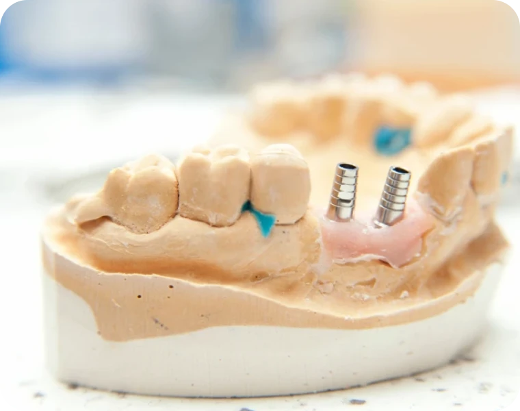 Implants dentaires