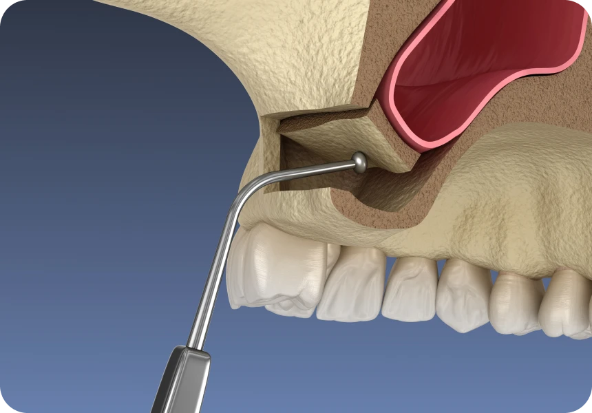 Implants dentaires