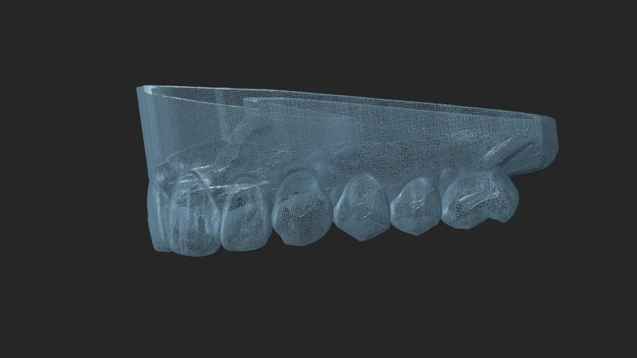 Complet fixe sur implants : modélisation 3D de l'arcade