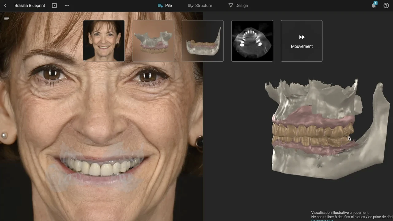Complet fixe sur implants : planification numérique du sourire