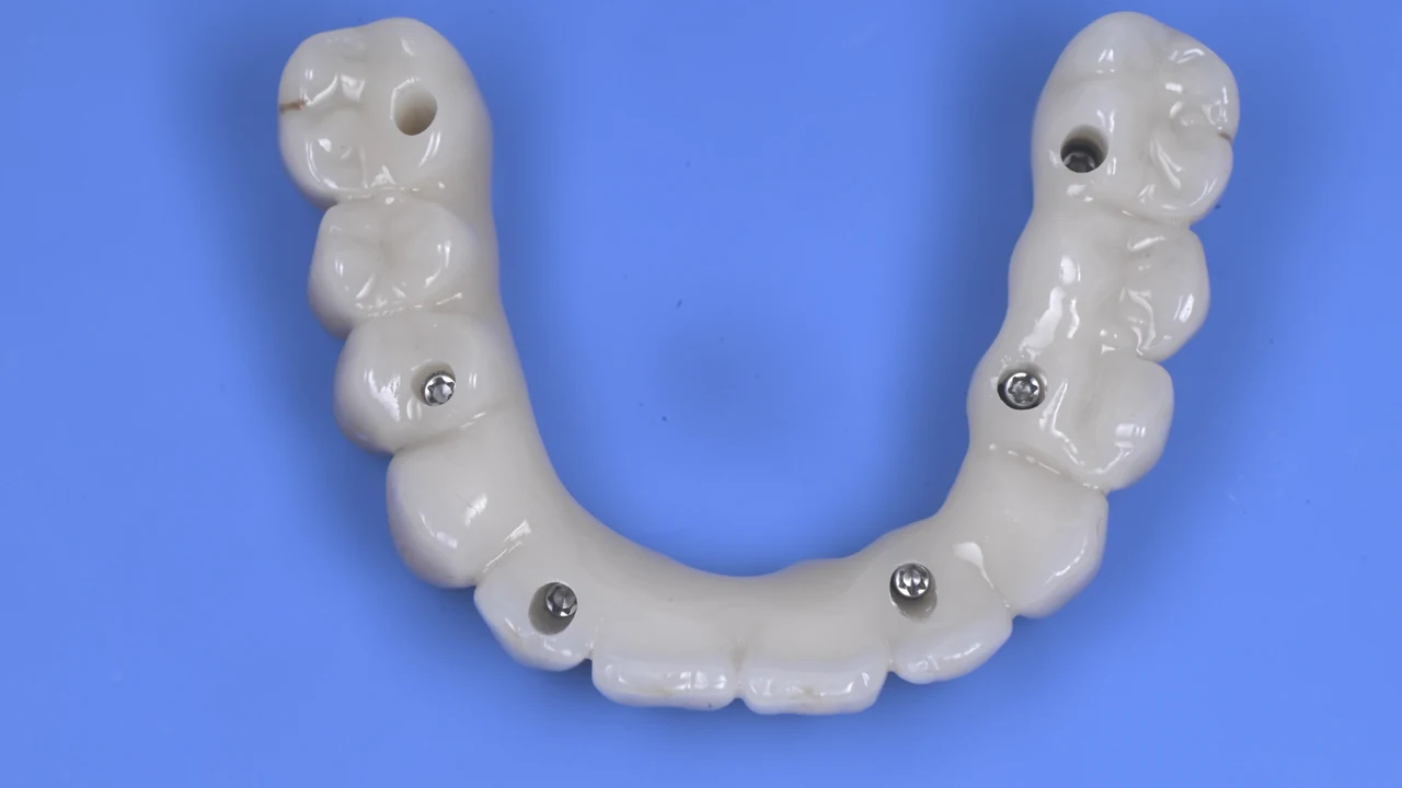 Complet fixe sur implants : prothèse fixe sur implants