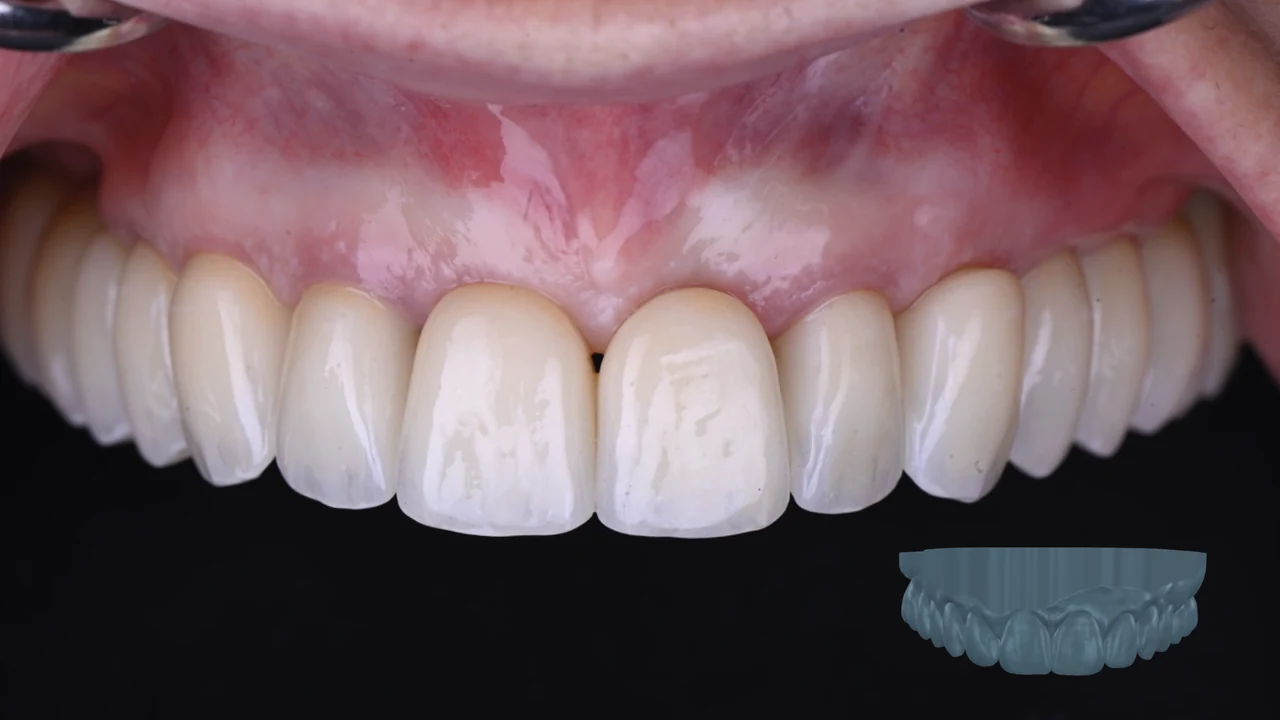 Complet fixe sur implants : provisoire optimisé au laboratoire