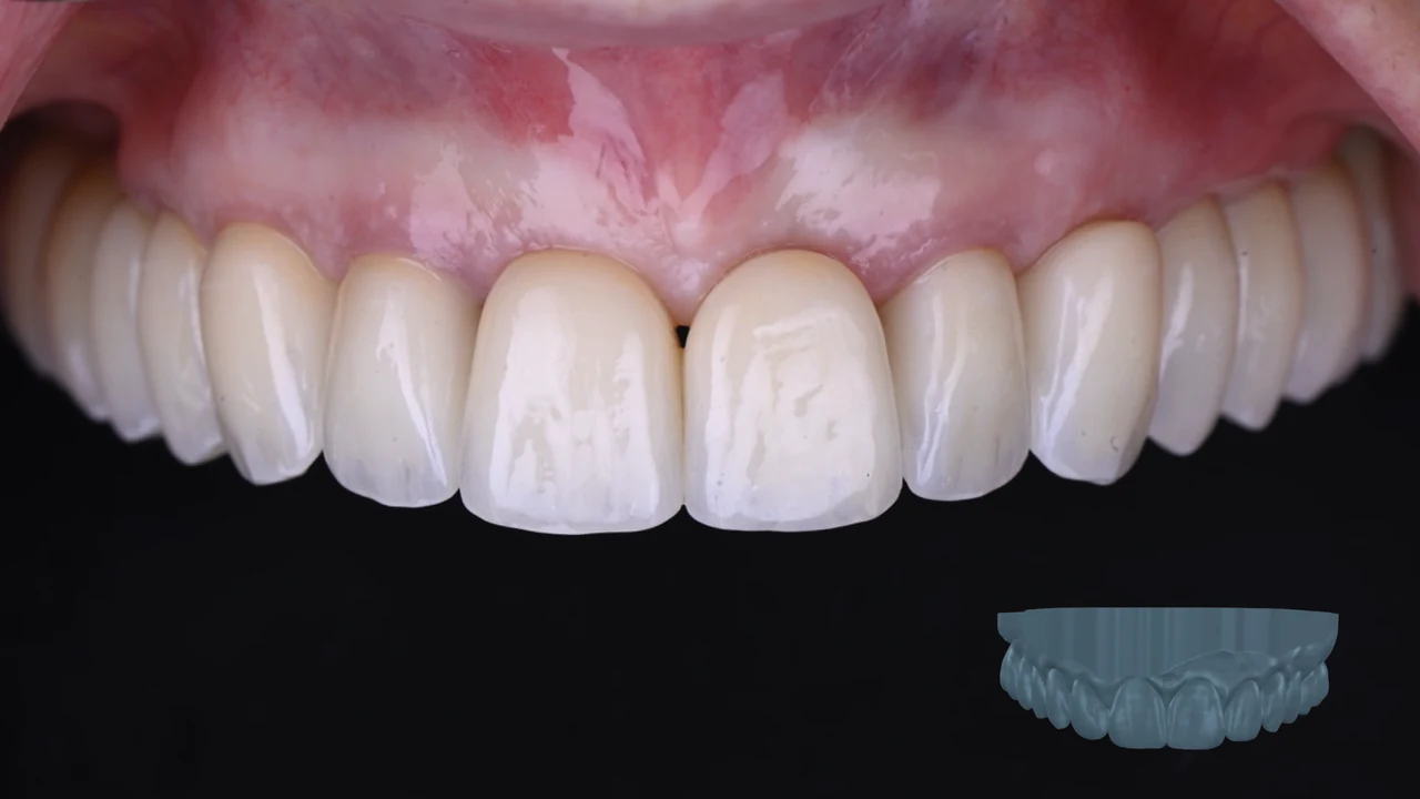 Complet fixe sur implants : sourire définitif