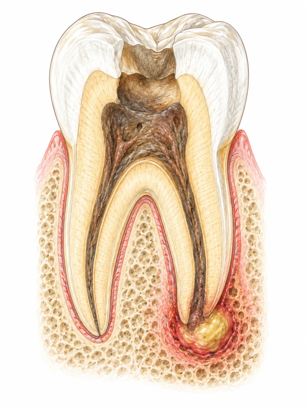 Schéma d’un abcès apical aigu au niveau de l’extrémité d’une racine
