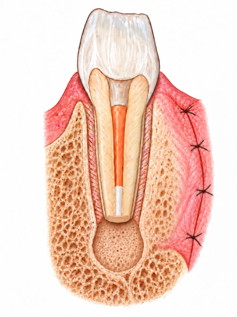 Sutures après microchirurgie endodontique