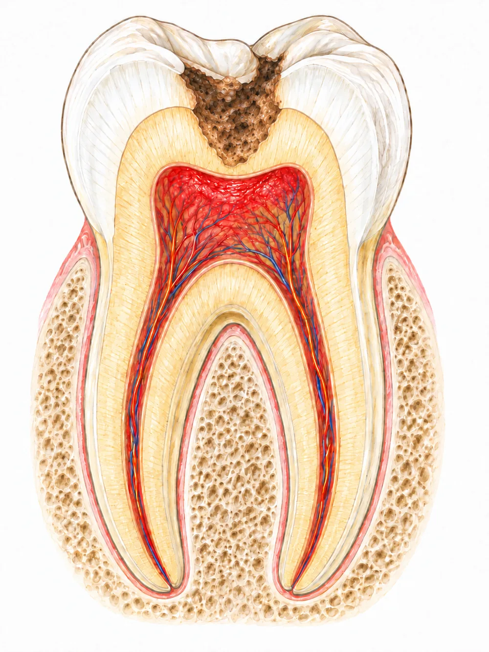 Schéma d’une pulpite aiguë irréversible avec pulpe dentaire inflammatoire