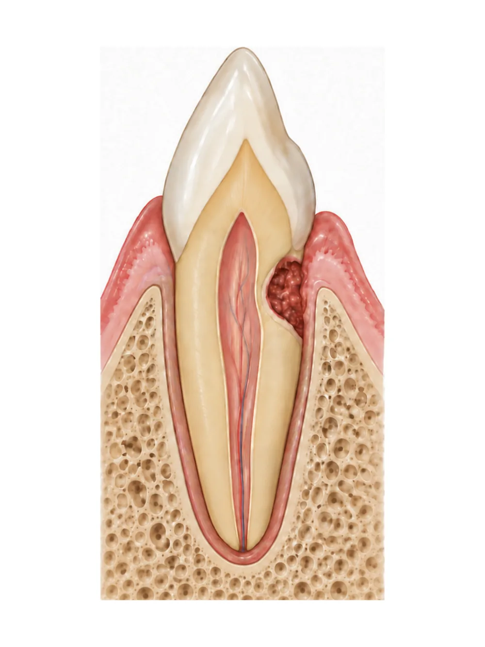Schéma du diagnostic d’une résorption cervicale externe