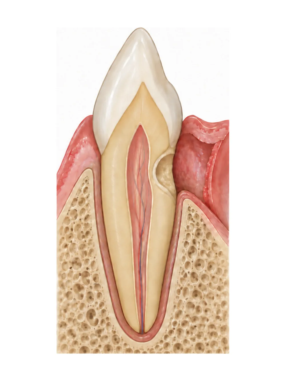 Schéma du débridement d’une résorption cervicale externe