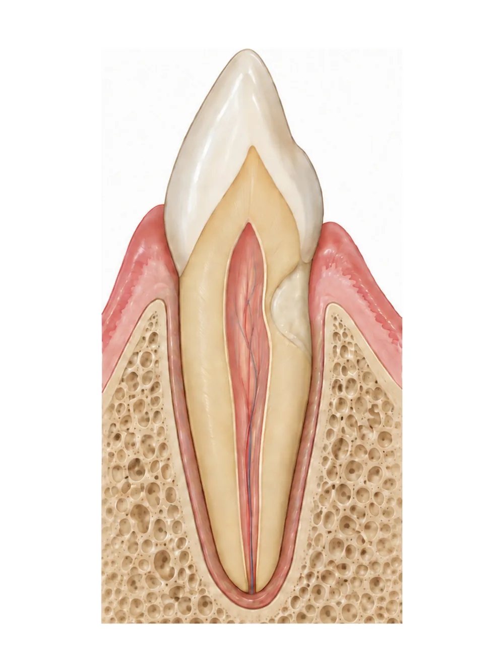 Schéma de la restauration d’une résorption cervicale externe