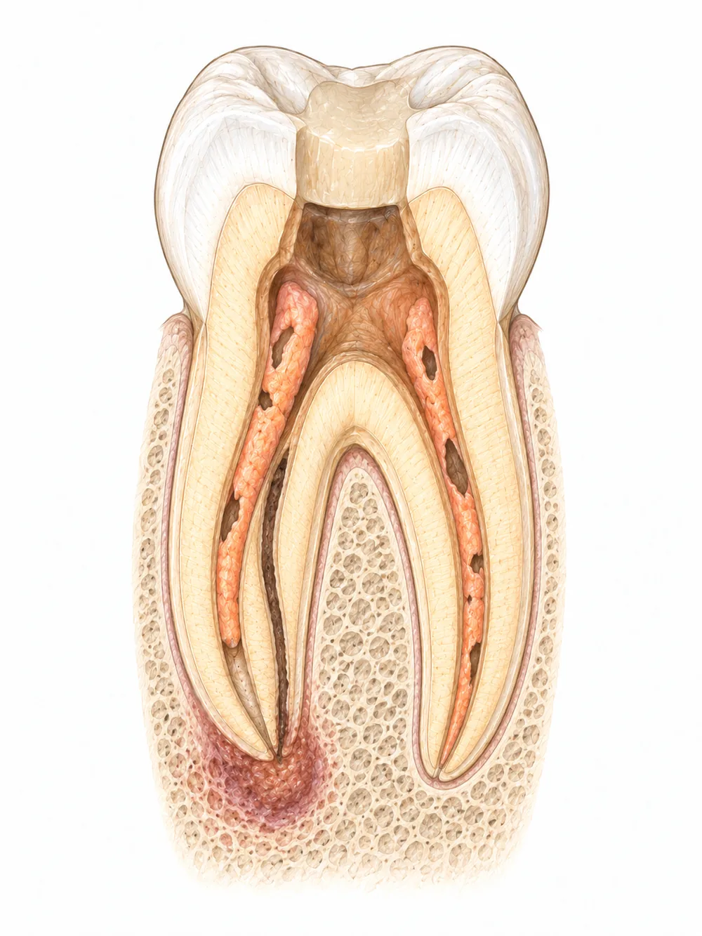 Ancien traitement endodontique avec un canal non traité