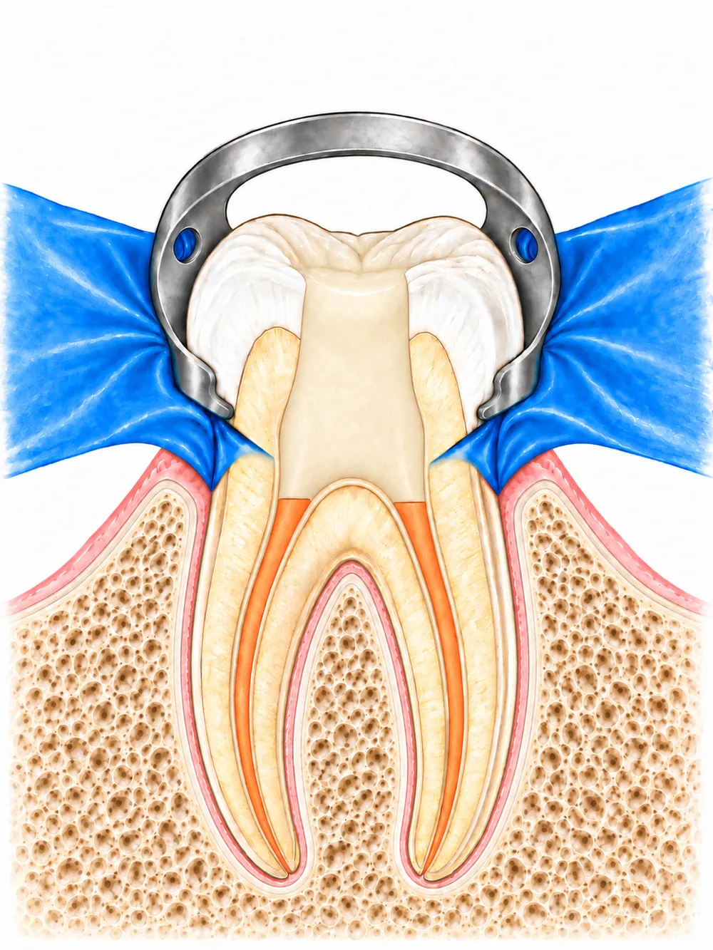 Scellement coronaire après traitement endodontique