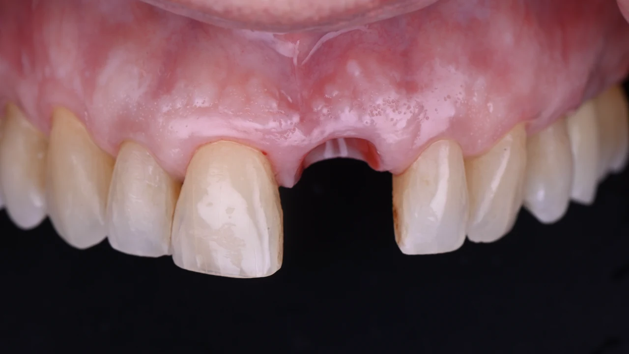 Implant esthétique et provisoire immédiat : alvéole après extraction de l'incisive