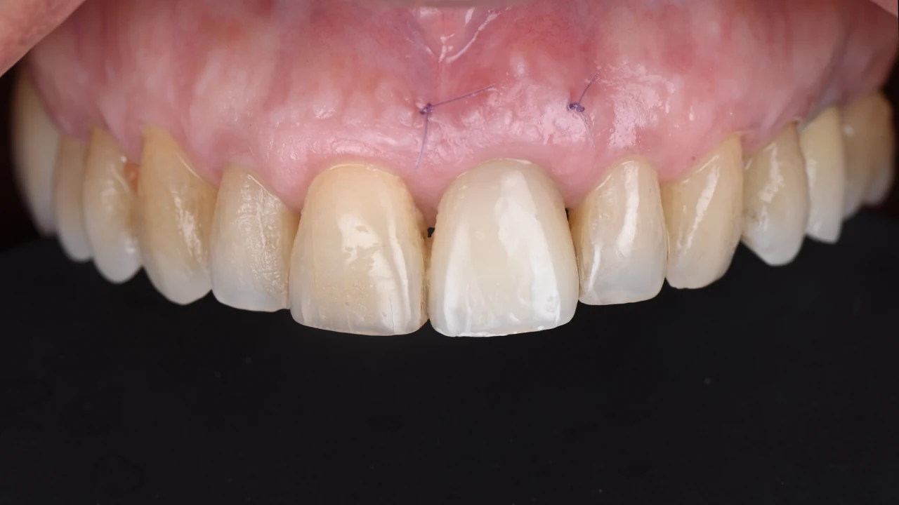Implant esthétique et provisoire immédiat : incisive remplacée, vue de face