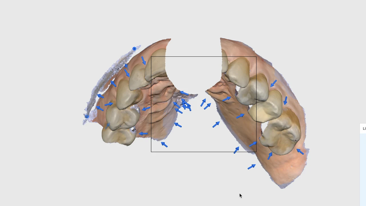 Implant esthétique et provisoire immédiat : empreinte numérique en 3D