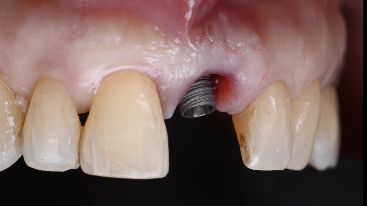 Implant esthétique et provisoire immédiat : implant posé, vue de face