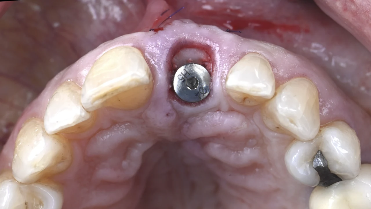 Implant esthétique et provisoire immédiat : implant en place, vue palatine