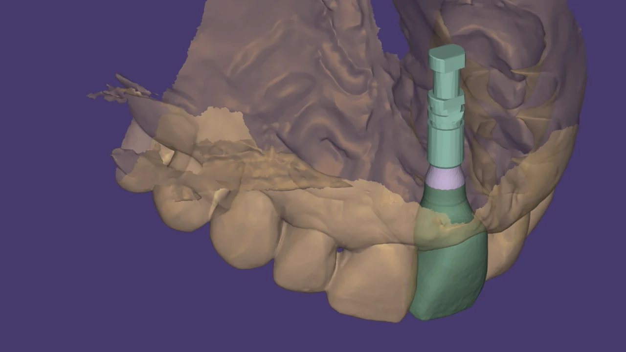 Implant esthétique et provisoire immédiat : conception numérique du pilier