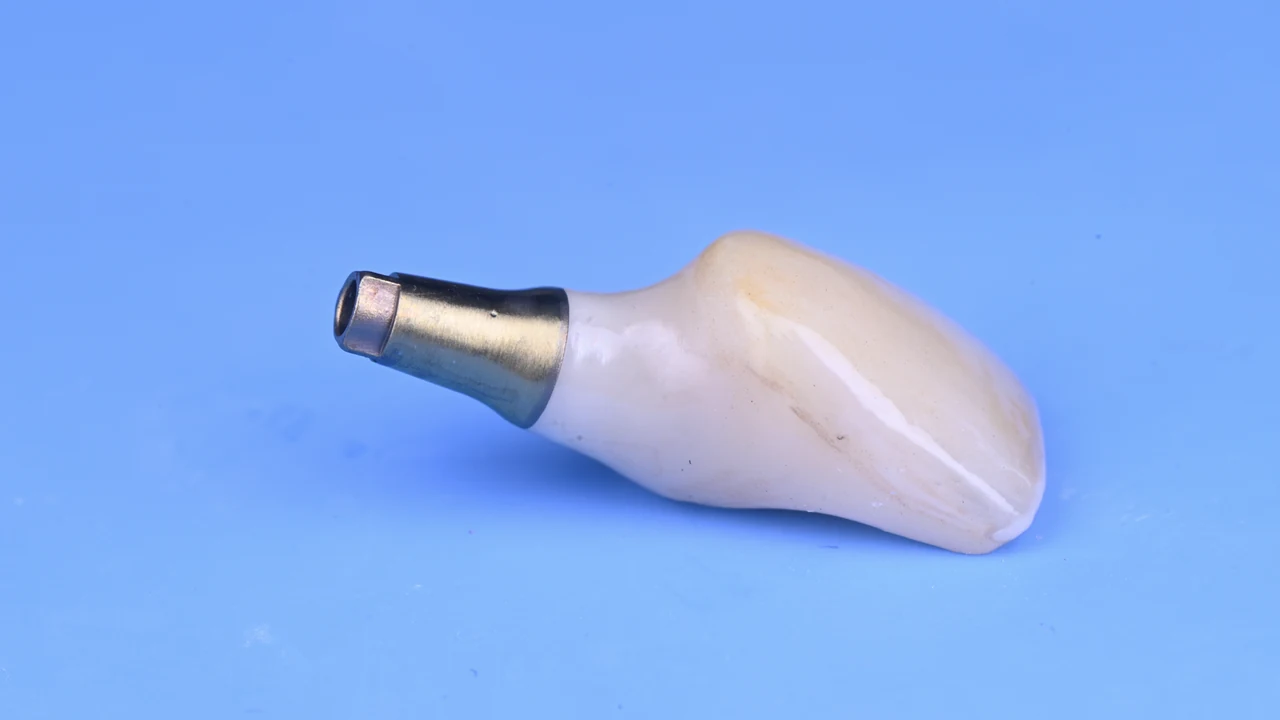 Implant esthétique et provisoire immédiat : couronne sur son pilier