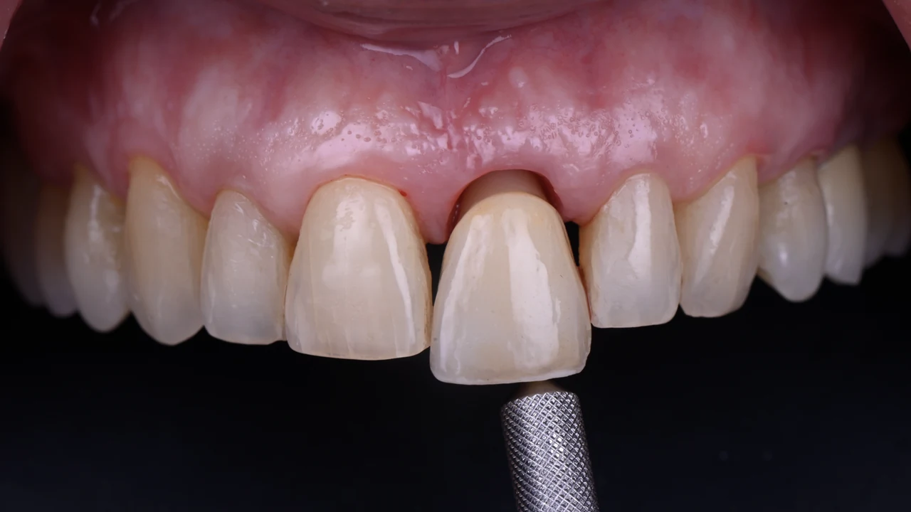 Implant esthétique et provisoire immédiat : vissage de la couronne