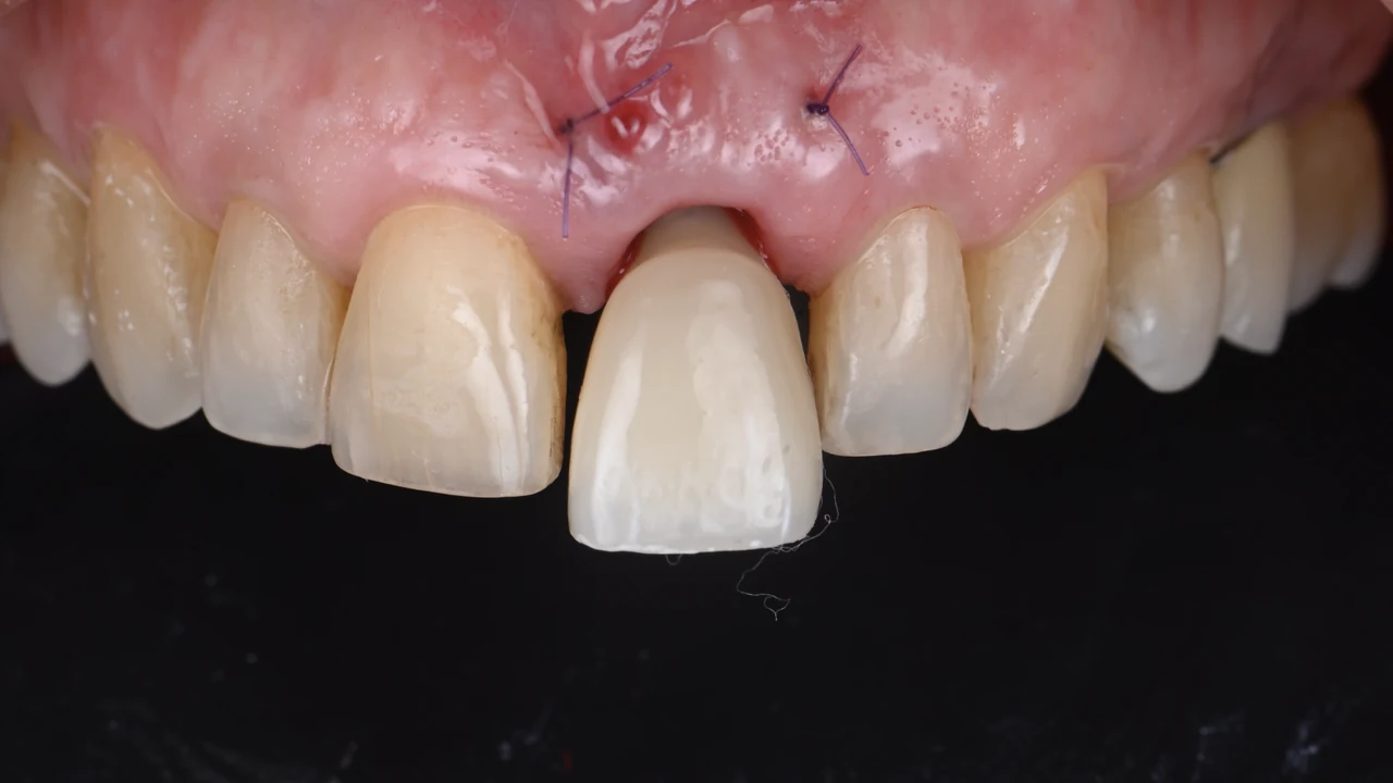 Implant esthétique et provisoire immédiat : couronne provisoire en place, vue de face