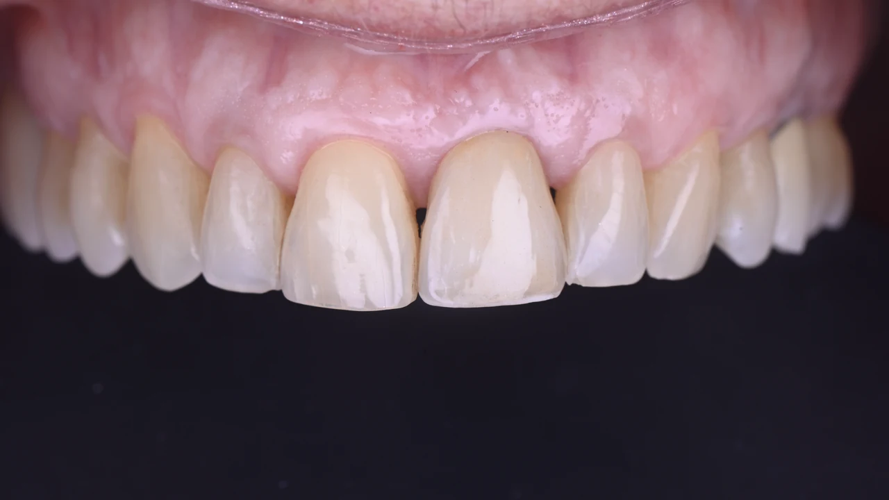 Implant esthétique et provisoire immédiat : sourire final, vue de face