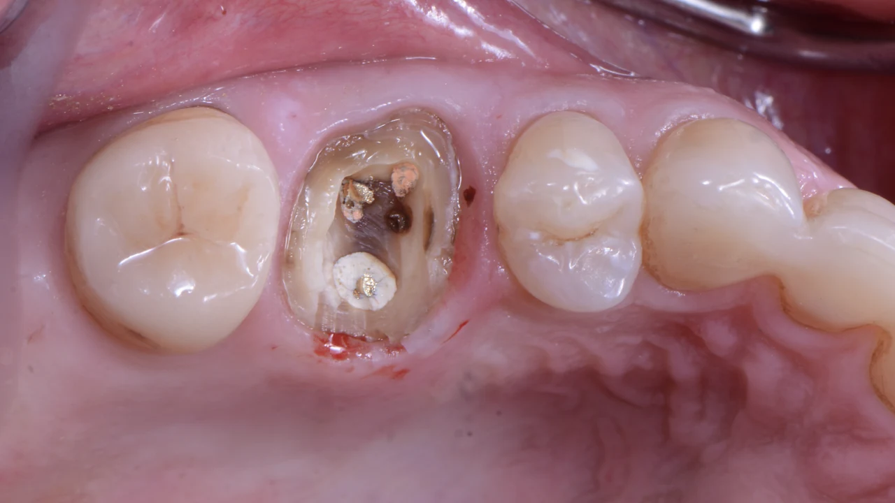 Implant molaire immédiat et protocole SSA : molaire cariée avant extraction, vue occlusale