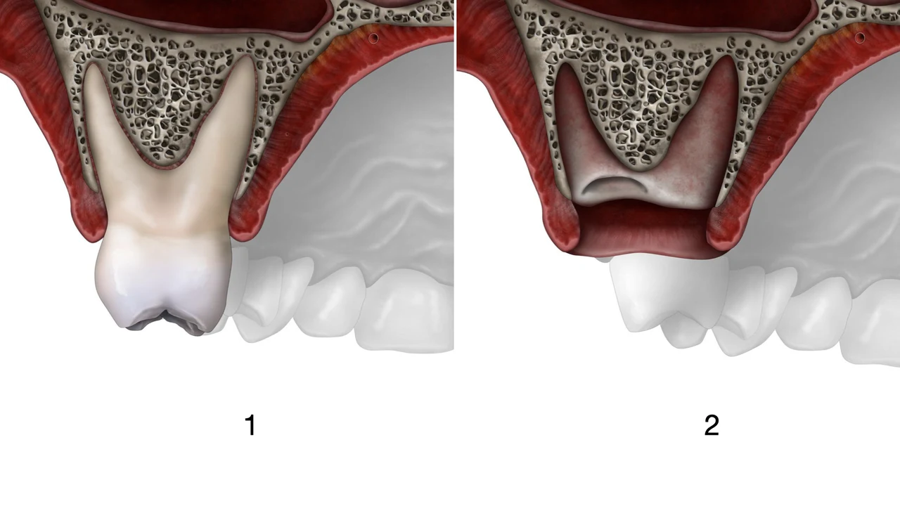 Implant molaire immédiat et protocole SSA : schéma de l'extraction et de l'alvéole