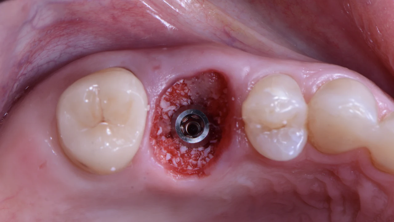 Implant molaire immédiat et protocole SSA : implant dans l'alvéole d'extraction, vue occlusale