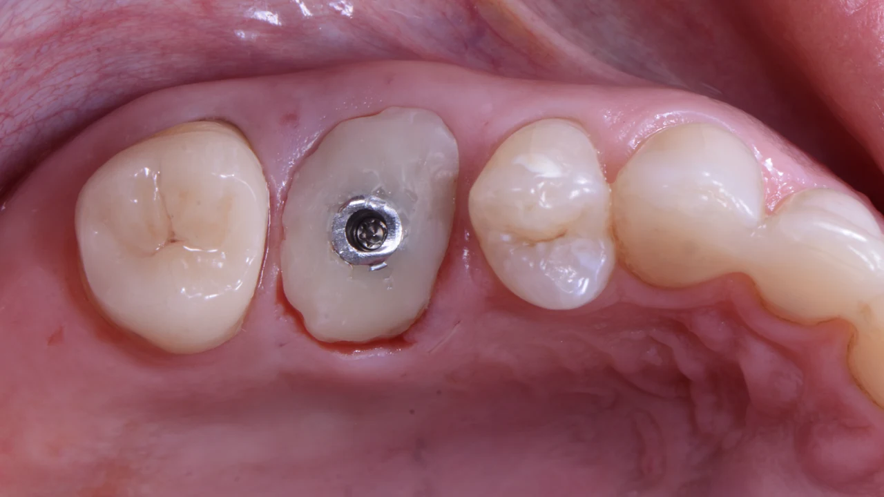 Implant molaire immédiat et protocole SSA : pilier SSA en place, vue occlusale