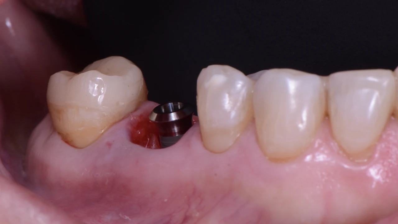 Implant molaire immédiat et protocole SSA : implant et pilier, vue latérale