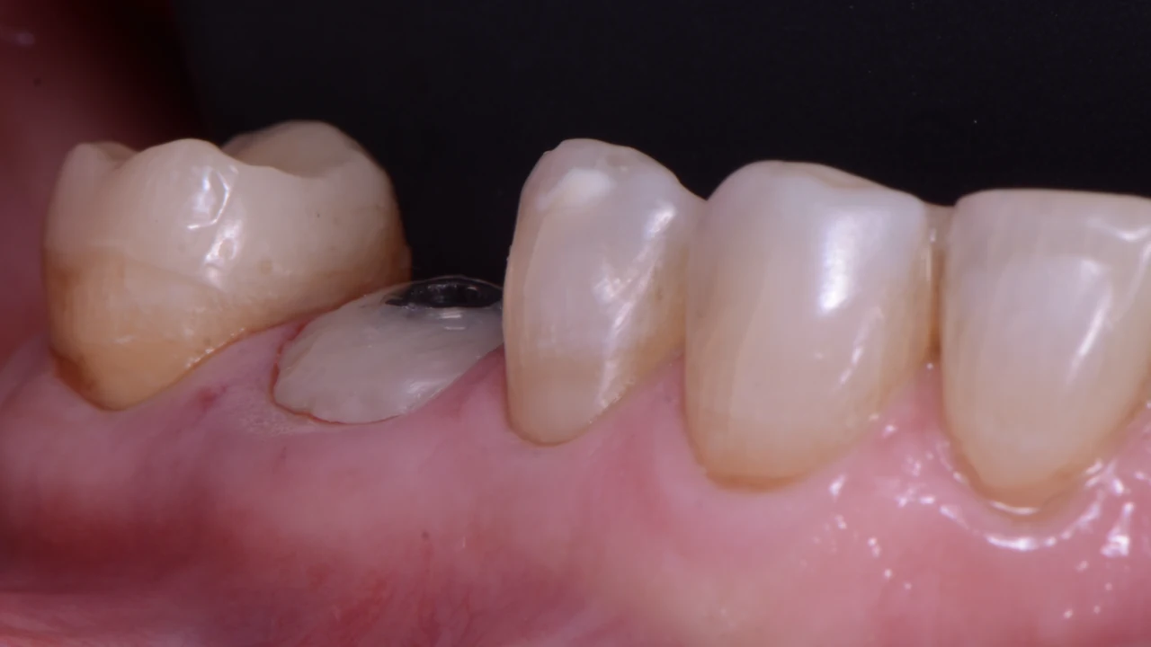 Implant molaire immédiat et protocole SSA : pilier SSA et gencive cicatrisée, vue latérale