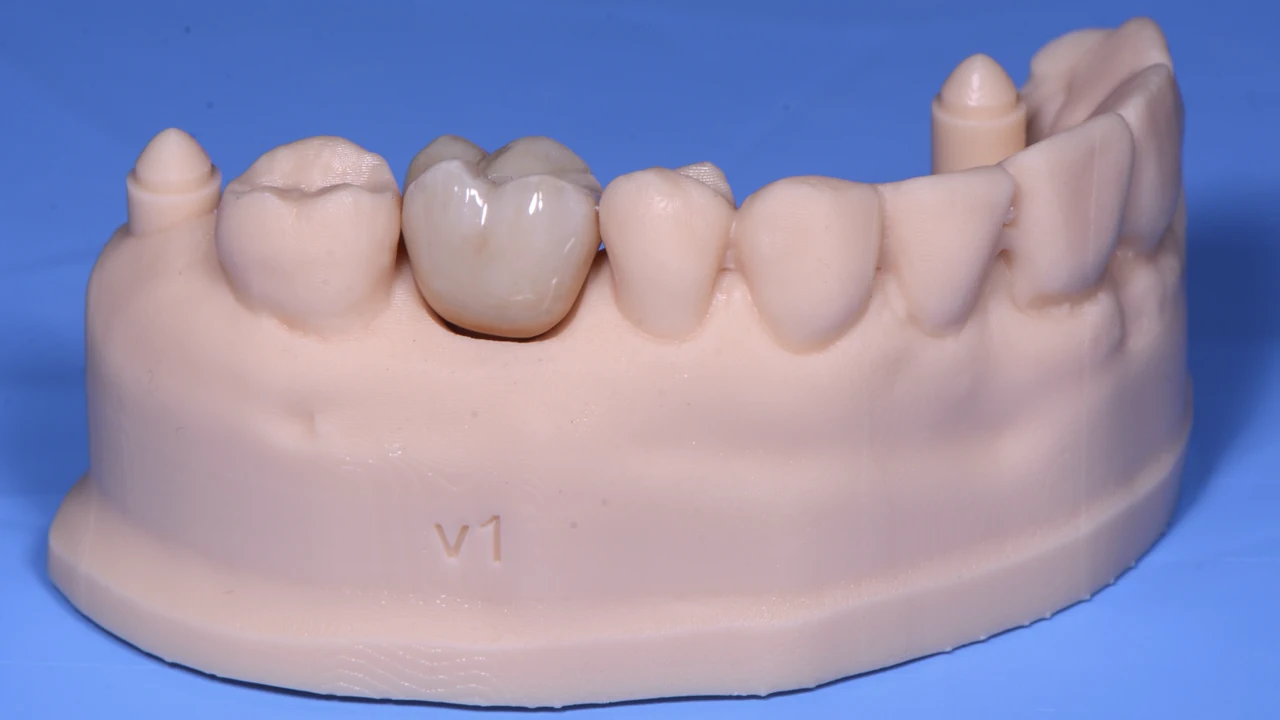 Implant molaire immédiat et protocole SSA : modèle de laboratoire avec la couronne